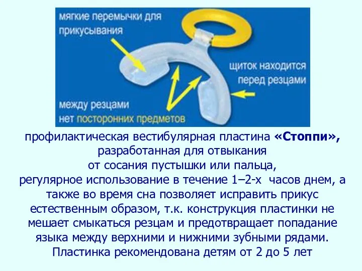 профилактическая вестибулярная пластина «Стоппи», разработанная для отвыкания от сосания пустышки или