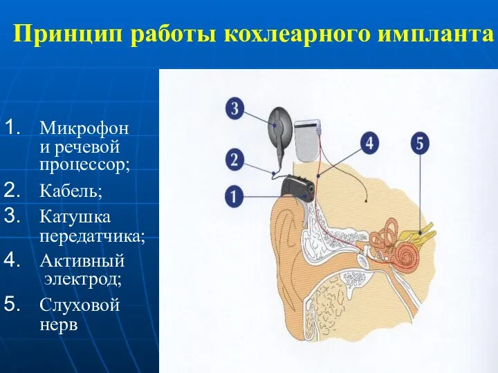 Принцип работы кохлеарного импланта Микрофон и речевой процессор; Кабель; Катушка передатчика; Активный электрод; Слуховой нерв