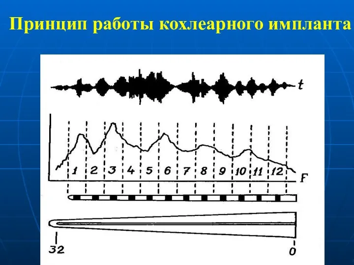 Принцип работы кохлеарного импланта