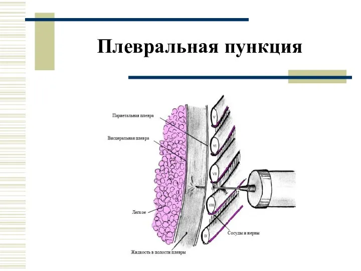 Плевральная пункция