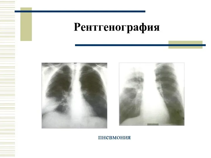 Рентгенография пневмония