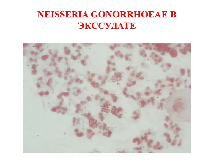 NEISSERIA GONORRHOEAE В ЭКССУДАТЕ