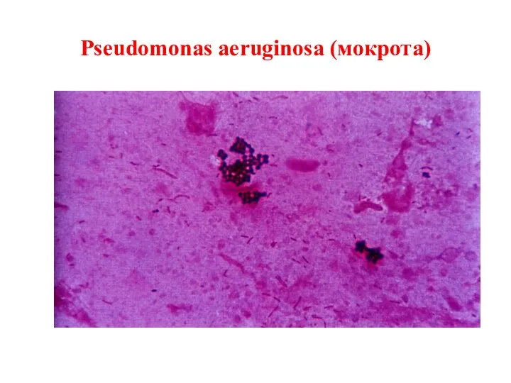 Pseudomonas aeruginosa (мокрота)