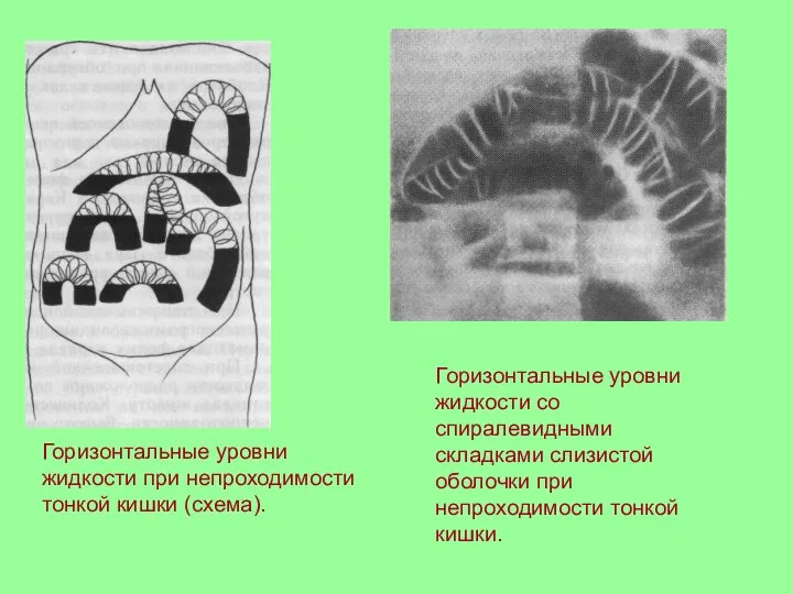 Горизонтальные уровни жидкости при непроходимости тонкой кишки (схема). Горизонтальные уровни жидкости