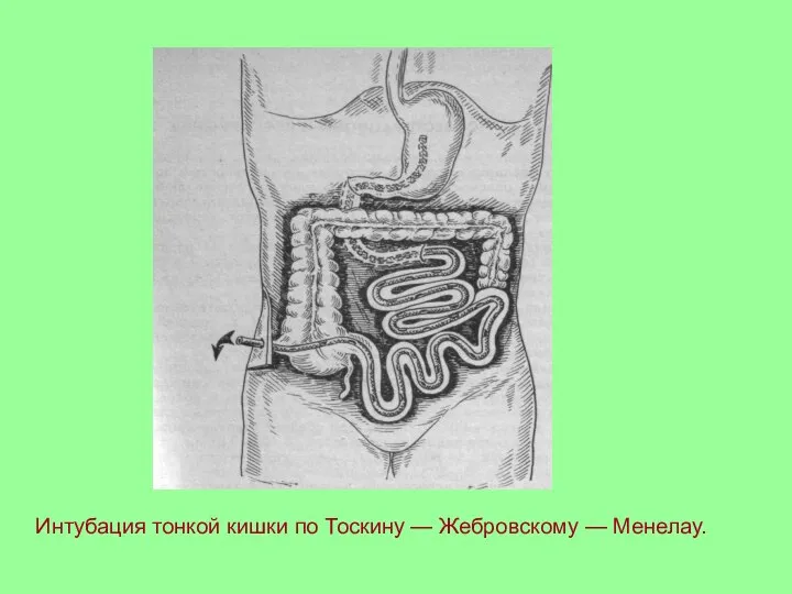 Интубация тонкой кишки по Тоскину — Жебровскому — Менелау.