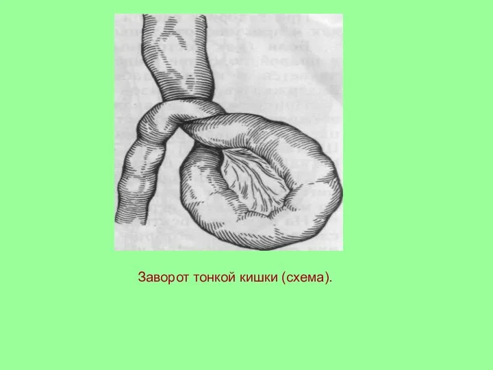 Заворот тонкой кишки (схема).