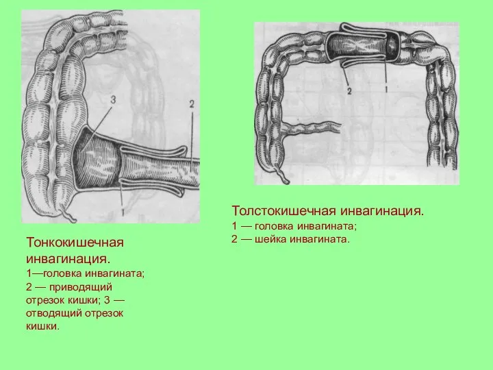 Тонкокишечная инвагинация. 1—головка инвагината; 2 — приводящий отрезок кишки; 3 —