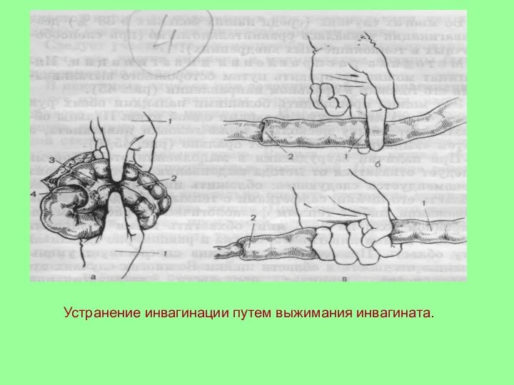 Устранение инвагинации путем выжимания инвагината.