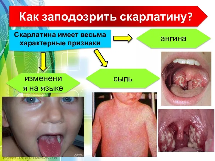 Как заподозрить скарлатину? Скарлатина имеет весьма характерные признаки ангина сыпь изменения на языке