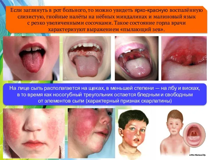 Если заглянуть в рот больного, то можно увидеть ярко-красную воспалённую слизистую,