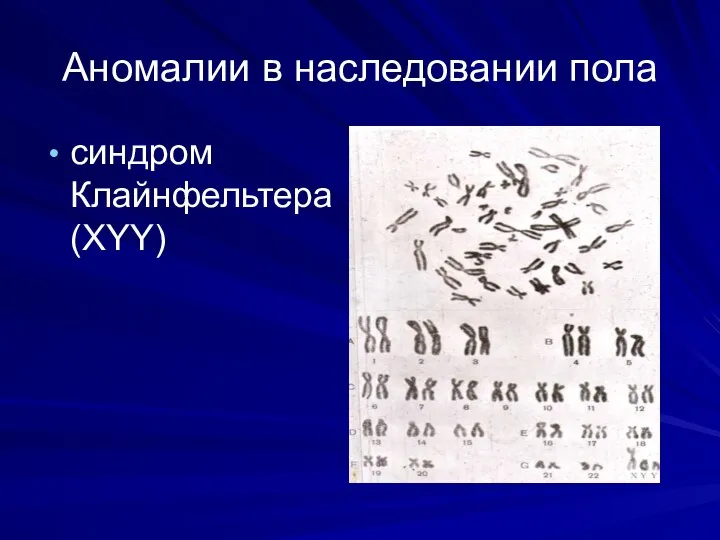 Аномалии в наследовании пола синдром Клайнфельтера (XYY)