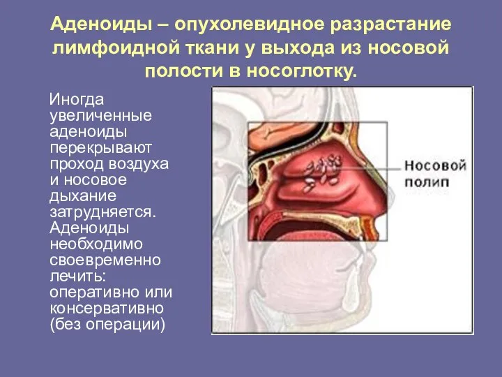 Аденоиды – опухолевидное разрастание лимфоидной ткани у выхода из носовой полости