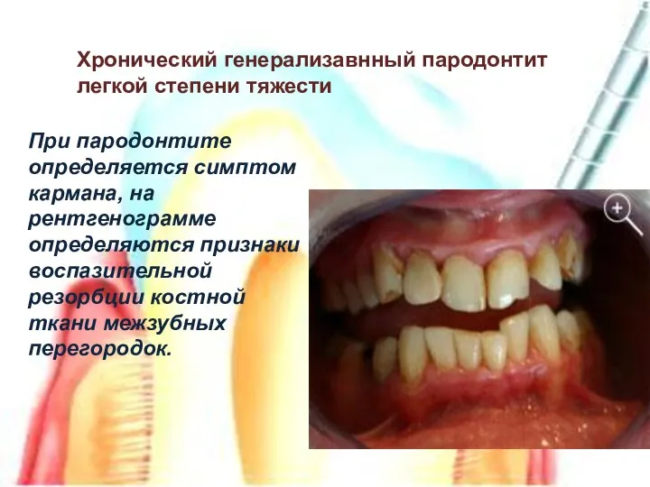 Хронический генерализавнный пародонтит легкой степени тяжести При пародонтите определяется симптом кармана,