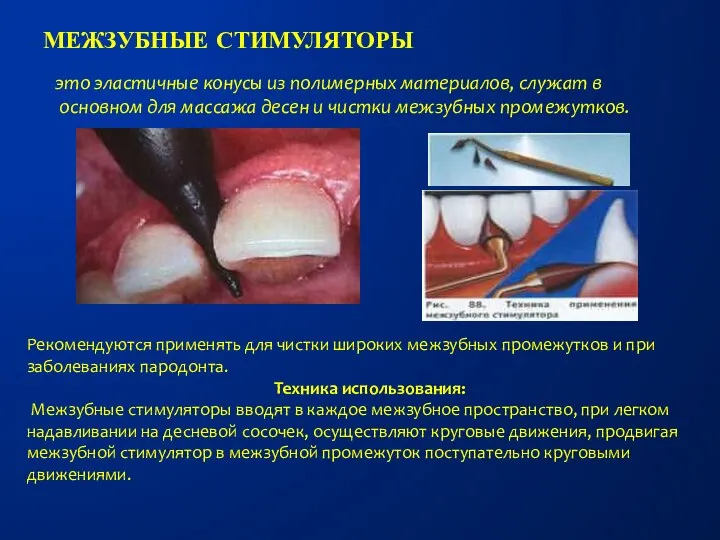 МЕЖЗУБНЫЕ СТИМУЛЯТОРЫ это эластичные конусы из полимерных материалов, служат в основном