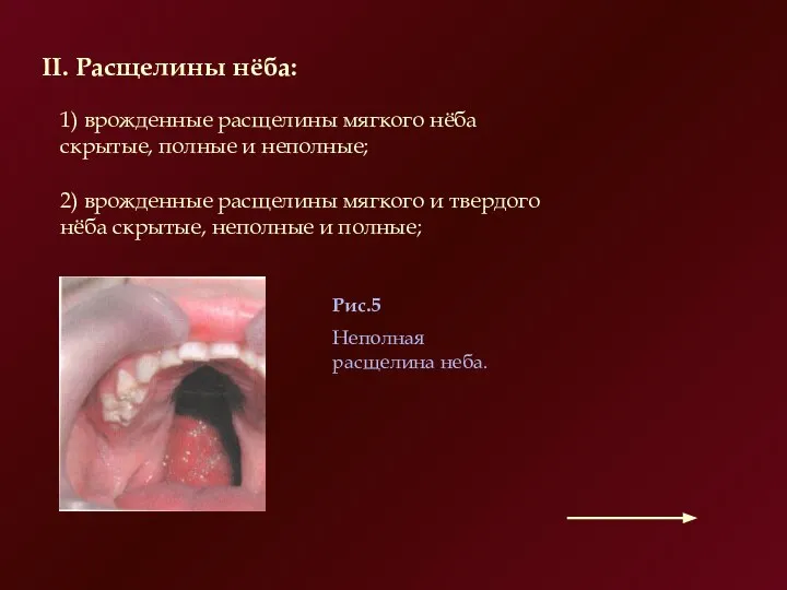 II. Расщелины нёба: 1) врожденные расщелины мягкого нёба скрытые, полные и