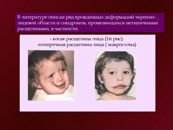 В литературе описан ряд врожденных деформаций черепно-лицевой области и синдромов, проявляющихся