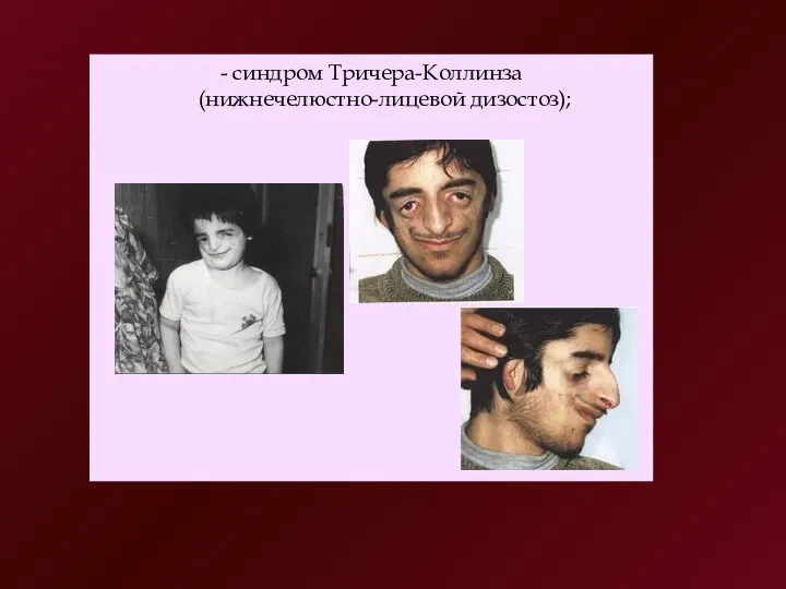 - синдром Тричера-Коллинза (нижнечелюстно-лицевой дизостоз);