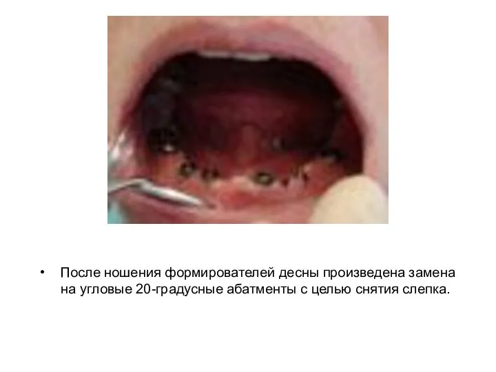 После ношения формирователей десны произведена замена на угловые 20-градусные абатменты с целью снятия слепка.