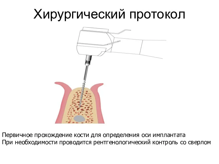 Хирургический протокол Первичное прохождение кости для определения оси имплантата При необходимости проводится рентгенологический контроль со сверлом