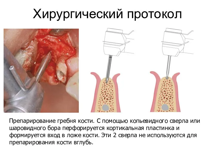 Хирургический протокол Препарирование гребня кости. С помощью копьевидного сверла или шаровидного