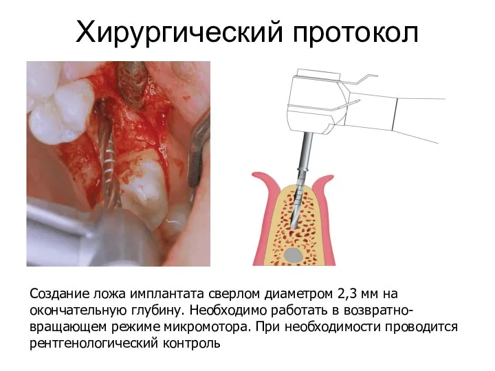 Хирургический протокол Создание ложа имплантата сверлом диаметром 2,3 мм на окончательную