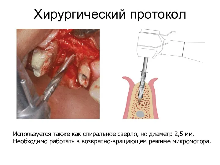 Хирургический протокол Используется также как спиральное сверло, но диаметр 2,5 мм.