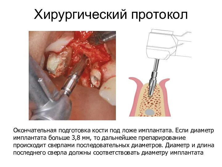 Хирургический протокол Окончательная подготовка кости под ложе имплантата. Если диаметр имплантата