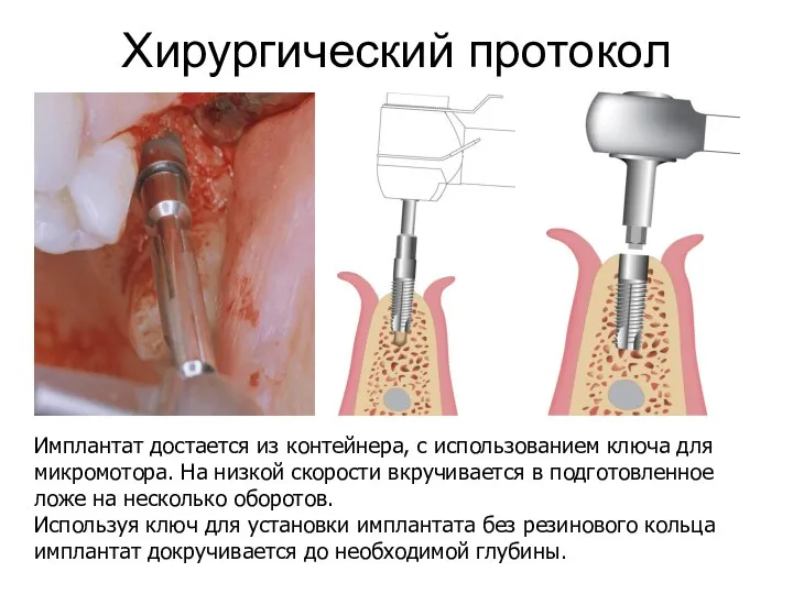 Хирургический протокол Имплантат достается из контейнера, с использованием ключа для микромотора.