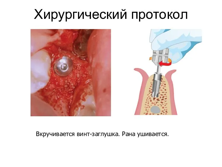 Хирургический протокол Вкручивается винт-заглушка. Рана ушивается.