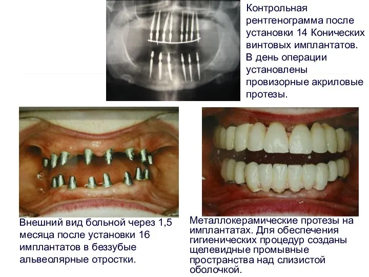 Металлокерамические протезы на имплантатах. Для обеспечения гигиенических процедур созданы щелевидные промывные