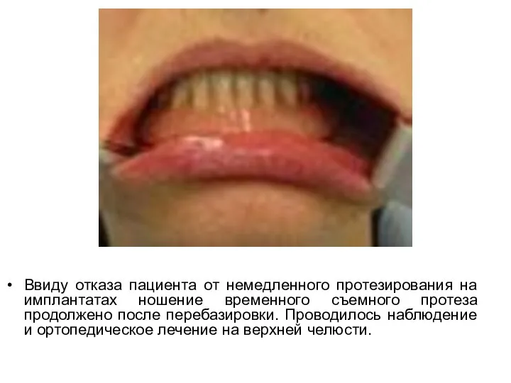 Ввиду отказа пациента от немедленного протезирования на имплантатах ношение временного съемного
