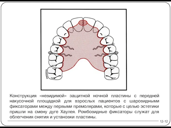 12-12 Конструкция «невидимой» защитной ночной пластины с передней накусочной площадкой для