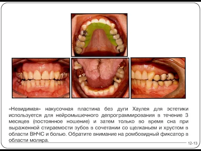 «Невидимая» накусочная пластина без дуги Хаулея для эстетики используется для нейромышечного