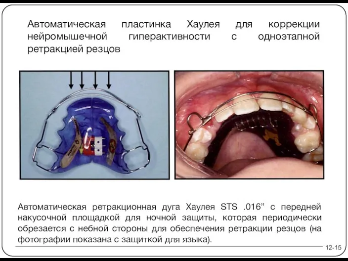 12-15 Автоматическая пластинка Хаулея для коррекции нейромышечной гиперактивности с одноэтапной ретракцией