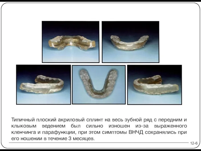 12-6 Типичный плоский акриловый сплинт на весь зубной ряд с передним