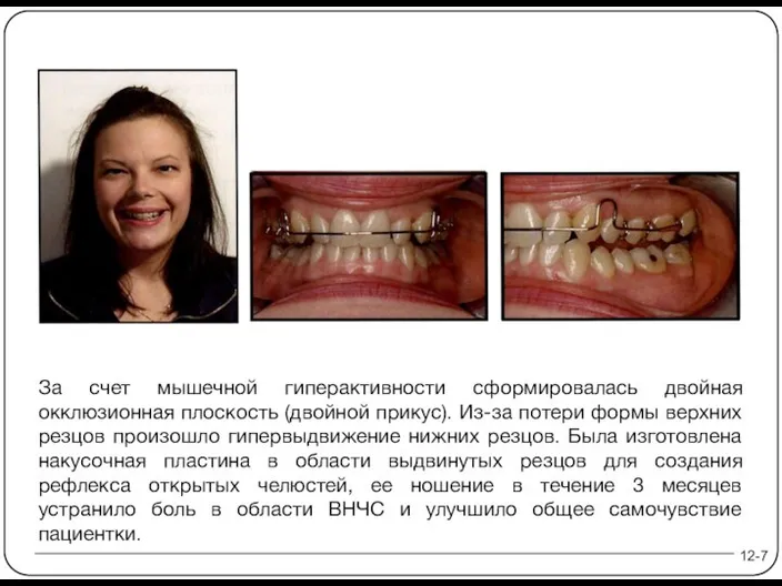 За счет мышечной гиперактивности сформировалась двойная окклюзионная плоскость (двойной прикус). Из-за