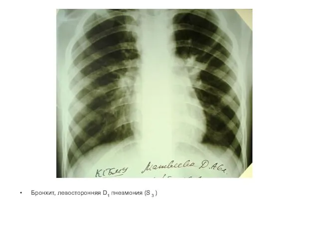 Бронхит, левосторонняя D1 пневмония (S 3 )