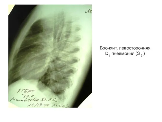 Бронхит, левосторонняя D1 пневмония (S 3 )