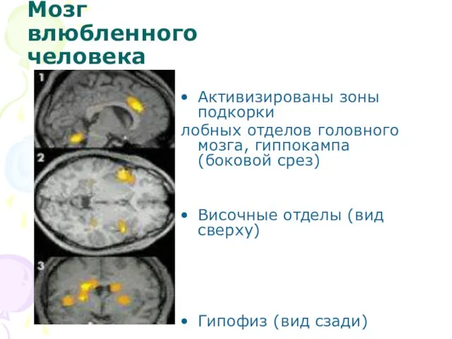 Мозг влюбленного человека Активизированы зоны подкорки лобных отделов головного мозга, гиппокампа