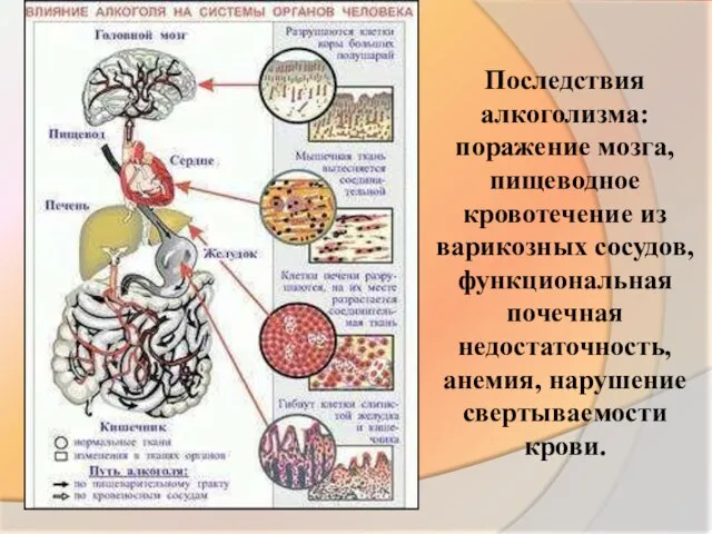 Последствия алкоголизма: поражение мозга, пищеводное кровотечение из варикозных сосудов, функциональная почечная недостаточность, анемия, нарушение свертываемости крови.