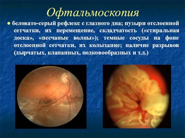 Офтальмоскопия ● беловато-серый рефлекс с глазного дна; пузыри отслоенной сетчатки, их