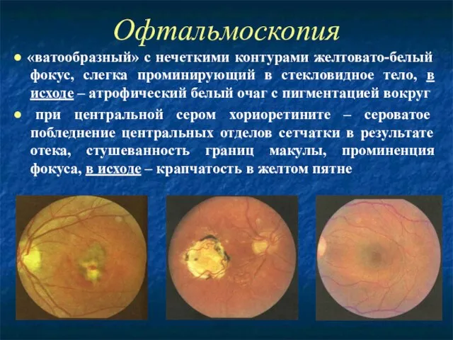 Офтальмоскопия ● «ватообразный» с нечеткими контурами желтовато-белый фокус, слегка проминирующий в