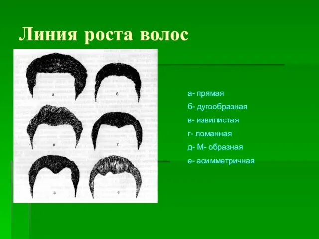 Линия роста волос а- прямая б- дугообразная в- извилистая г- ломанная д- М- образная е- асимметричная