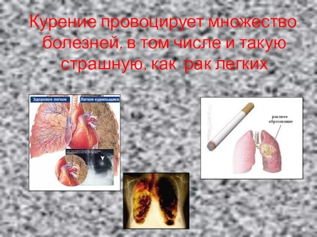 Курение провоцирует множество болезней, в том числе и такую страшную, как рак легких