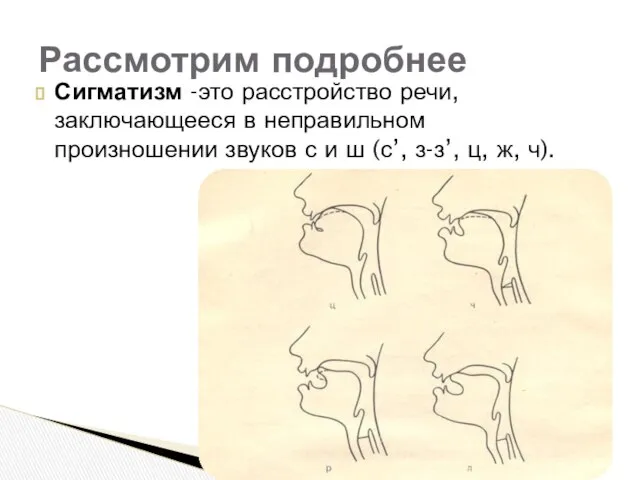 Сигматизм -это расстройство речи, заключающееся в неправильном произношении звуков с и