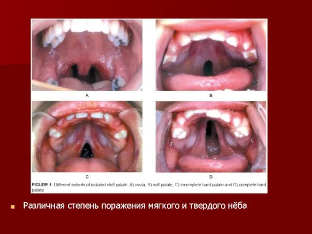 Различная степень поражения мягкого и твердого нёба