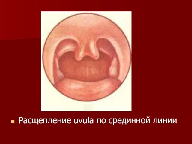 Расщепление uvula по срединной линии