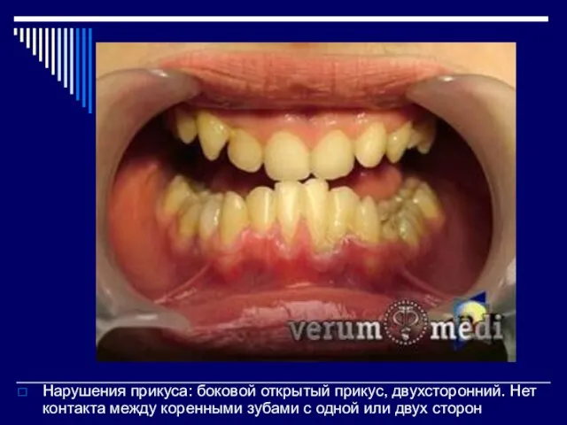 Нарушения прикуса: боковой открытый прикус, двухсторонний. Нет контакта между коренными зубами с одной или двух сторон