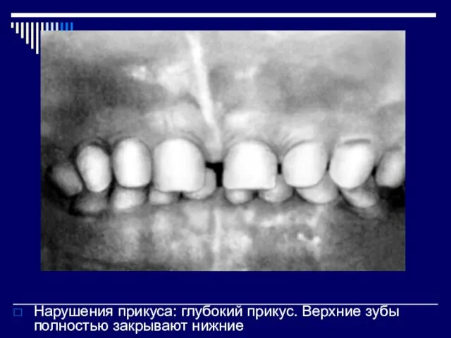 Нарушения прикуса: глубокий прикус. Верхние зубы полностью закрывают нижние