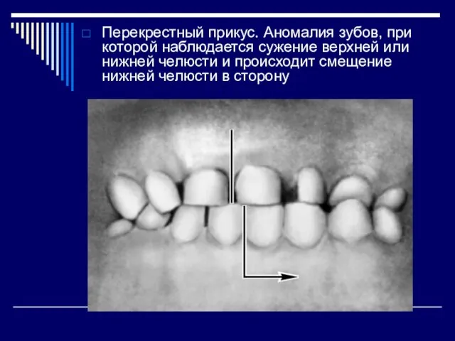 Перекрестный прикус. Аномалия зубов, при которой наблюдается сужение верхней или нижней